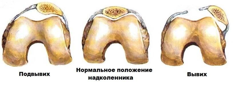 Смещение надколенника Смещение надколенника