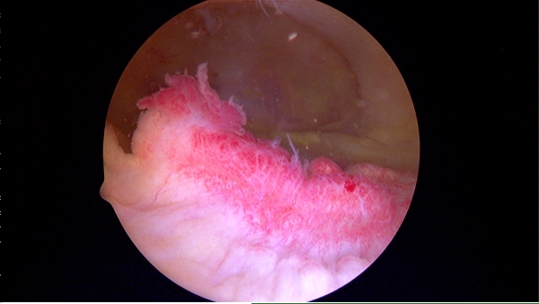 Снимок воспаления мениска при артроскопии Снимок воспаления мениска при артроскопии