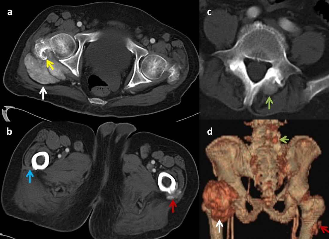 Снимок тазобедренного сустава на КТ томографе Снимок тазобедренного сустава на КТ томографе