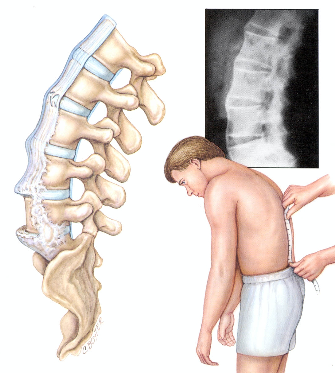 Снижение подвижности при спондилоартрозе Снижение подвижности при спондилоартрозе