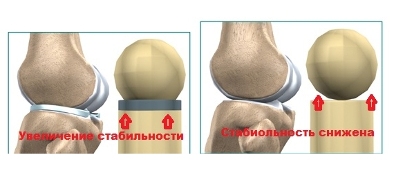 Снижение стабильности при отсутствии мениска Снижение стабильности при отсутствии мениска
