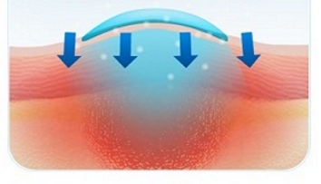 Снижение воспаления Снижение воспаления