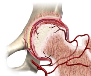 Сокращение кровообращения головки бедра Сокращение кровообращения головки бедра