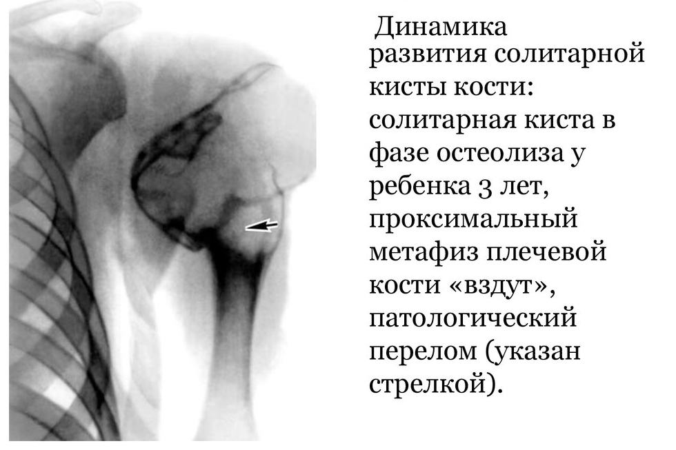 Солитарная костная киста Солитарная костная киста