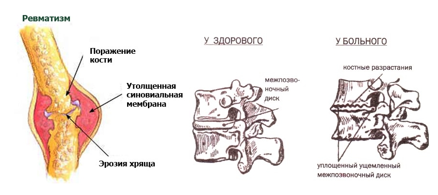 Сопровождающие факторы остеопойкилии