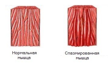 Спазм мышц Спазм мышц