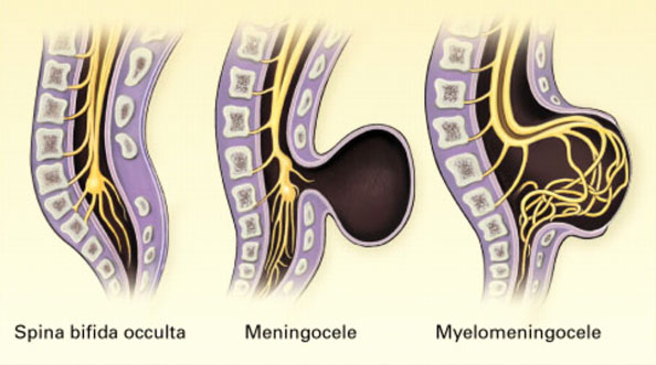 Степени развития спины Бифида Степени развития спины Бифида