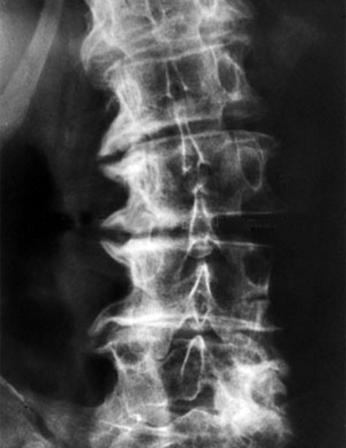 Спондилез поясничного отдела на рентгене Спондилез поясничного отдела на рентгене