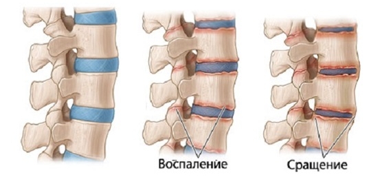 Костное заращение позвонков при спондилите Костное заращение позвонков при спондилите