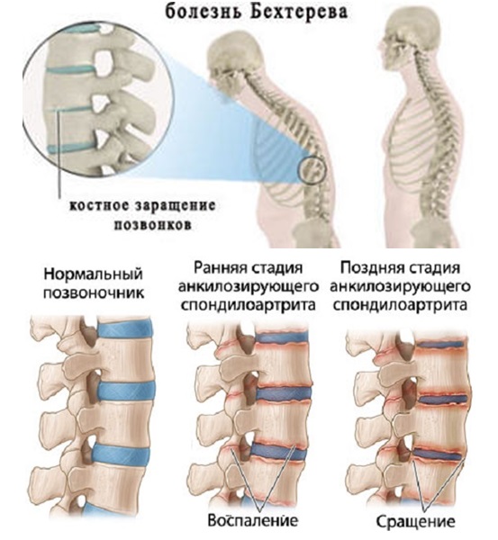 Спондилит — болезнь Бехтерева Спондилит — болезнь Бехтерева