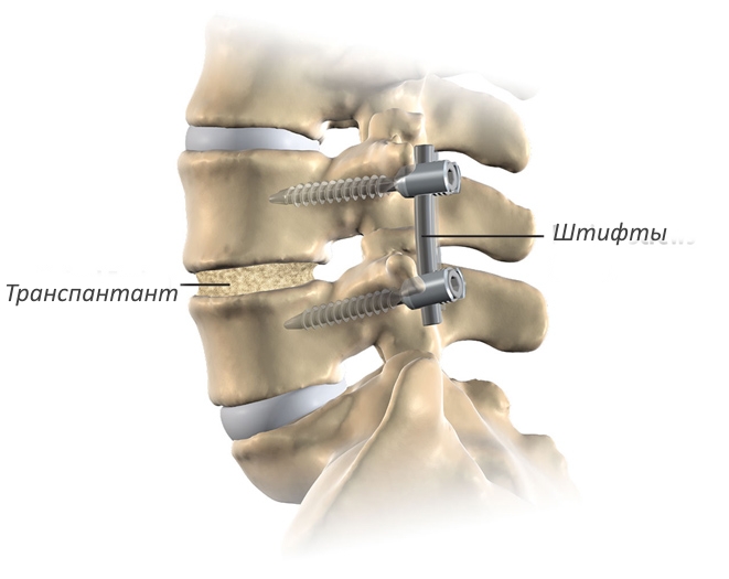 Операция спондилодез Операция спондилодез