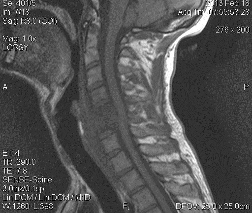 Спондилодисцит на МРТ Спондилодисцит на МРТ