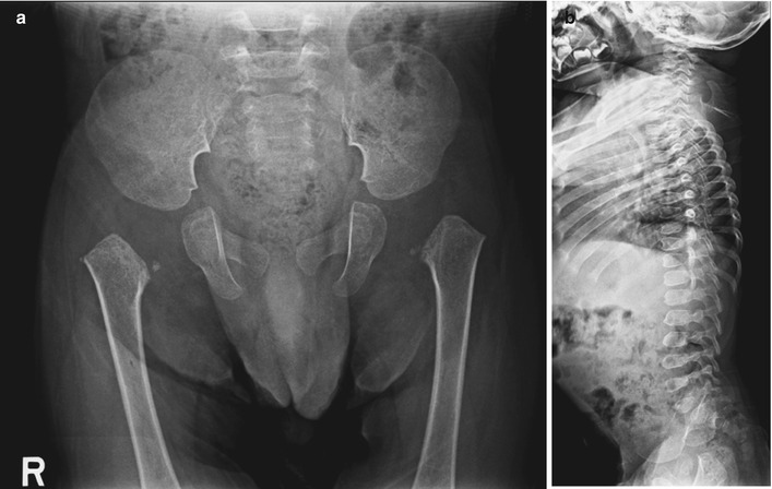 Спондилоэпифизарная дисплазия на рентген снимке Спондилоэпифизарная дисплазия на рентген снимке
