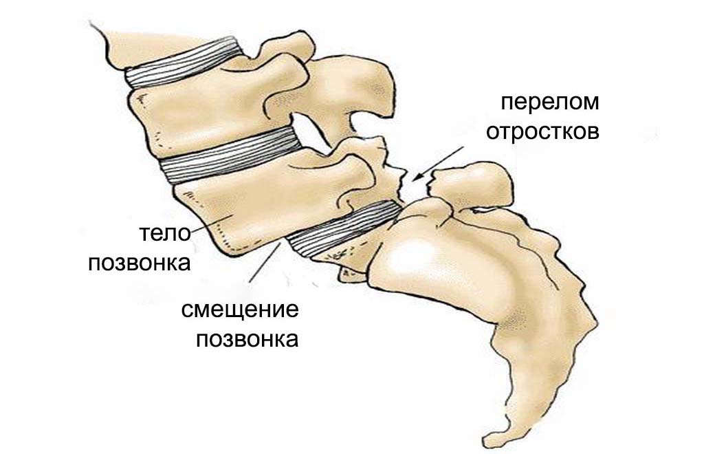 Спондилолистез Спондилолистез
