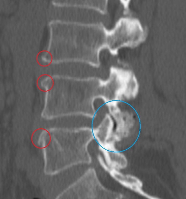 Спондилёз на рентген снимке Спондилёз на рентген снимке