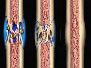 Ускорение срастания костей Ускорение срастания костей