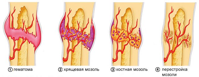 Срастание кости Срастание кости