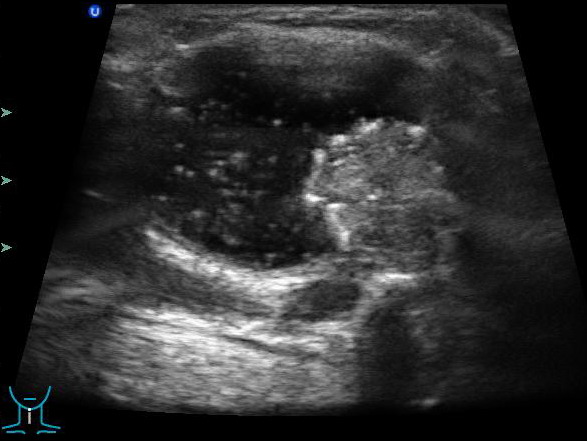 Срединная киста шеи на УЗИ Срединная киста шеи на УЗИ