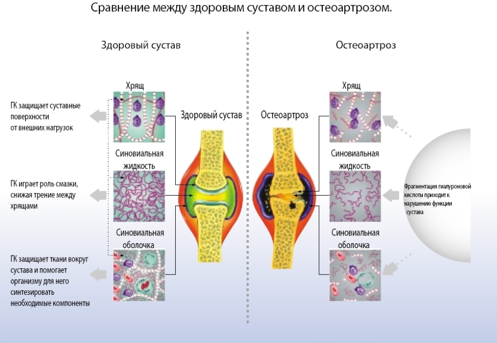 Срванение здорового сустава и остеоартроза Срванение здорового сустава и остеоартроза