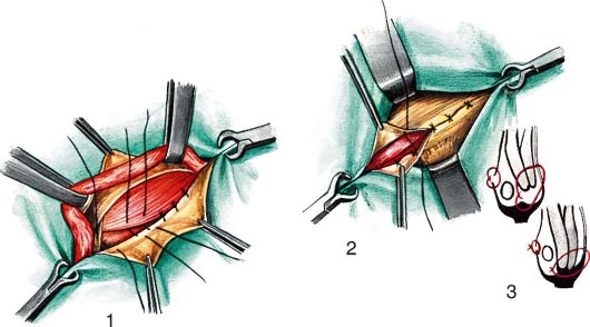 Оперативное сшивание мышц Оперативное сшивание мышц