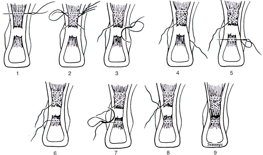 Сшивание разрыва Сшивание разрыва