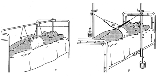 Стабилизация костей таза иммобилизацией Стабилизация костей таза иммобилизацией