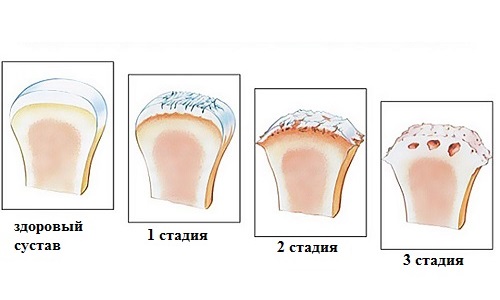 Стадии артроза Стадии артроза
