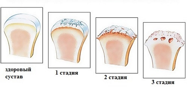 Стадии артроза Стадии артроза