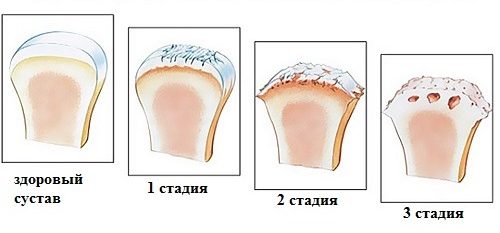 Стадии артроза Стадии артроза