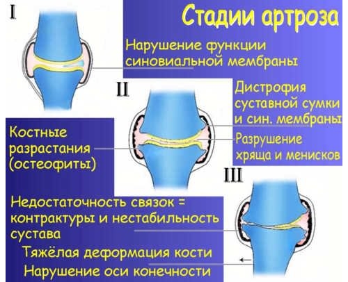 Стадии артроза Стадии артроза