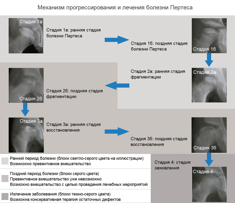 Стадии болезни Пертеса Стадии болезни Пертеса