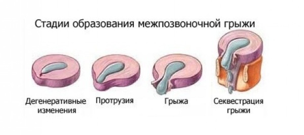 Стадии грыжи позвоночника Стадии грыжи позвоночника