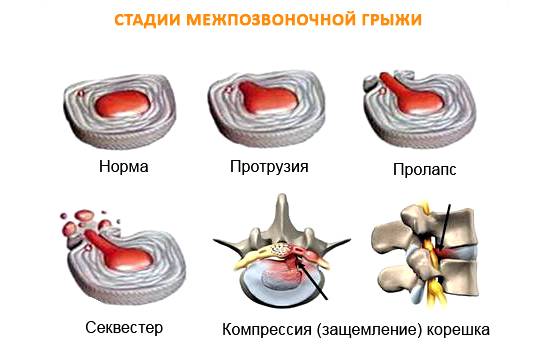 Стадии межпозвоночной грыжи Стадии межпозвоночной грыжи