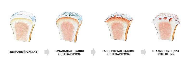Стадии артроза Стадии артроза