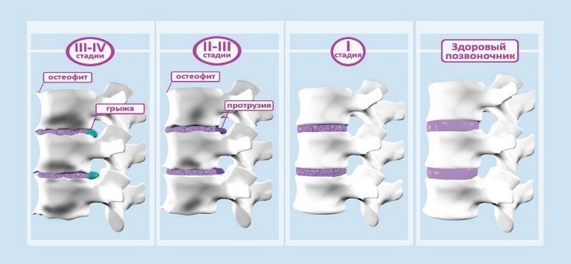Стадии остеохондроза Стадии остеохондроза