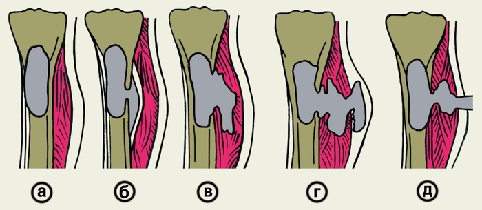 Стадии остеомиелита Стадии остеомиелита