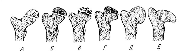 Стадии разрушения головки бедренной кости Стадии разрушения головки бедренной кости