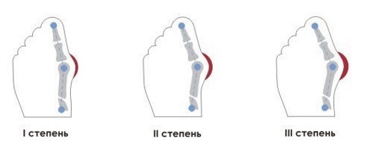Стадии деформации большого пальца стопы Стадии деформации большого пальца стопы