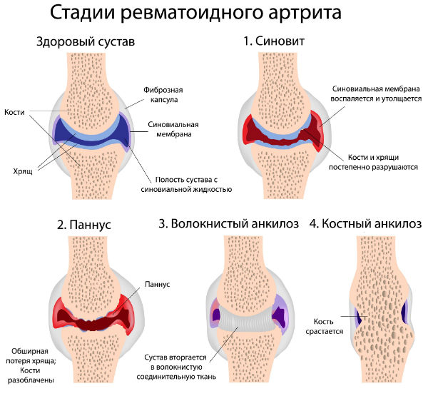 Стадии ревматоидного артрита Стадии ревматоидного артрита