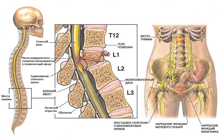 Стеноз на фоне компрессионного перелома Стеноз на фоне компрессионного перелома