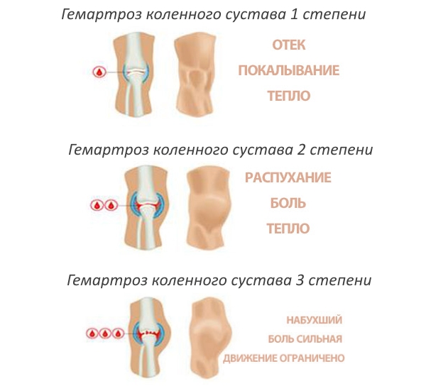 Степени гемартроза коленного сустава Степени гемартроза коленного сустава