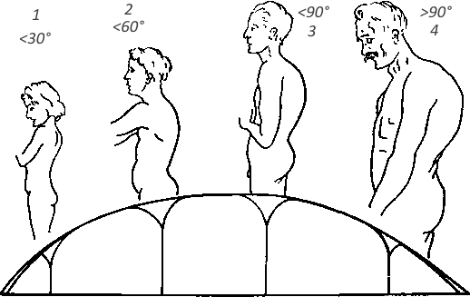 Степени кифоза Степени кифоза