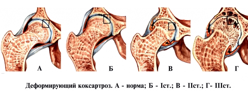 Степени коксартроза Степени коксартроза