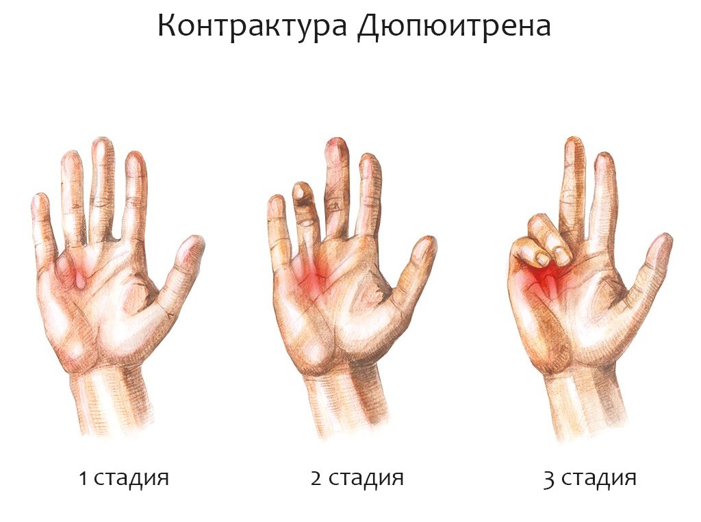 Степени контрактуры Дюпюитрена Степени контрактуры Дюпюитрена