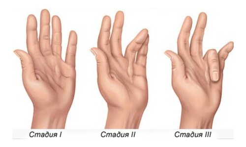 Cтепени контрактуры Cтепени контрактуры