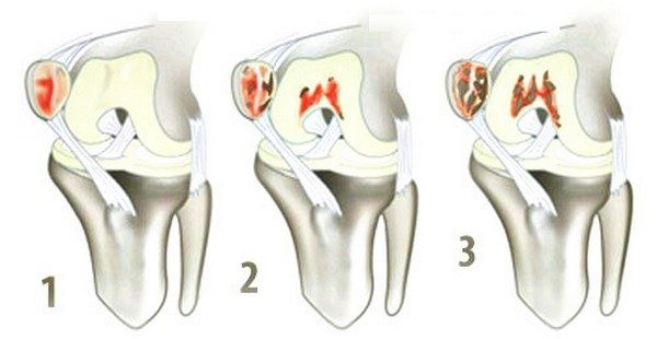 Степени пателлофеморального артроза Степени пателлофеморального артроза