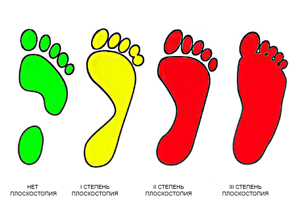 Степени плоскостопия Степени плоскостопия