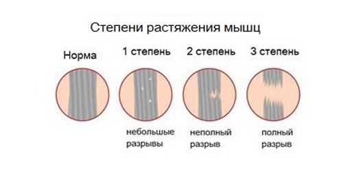 Степени растяжения мышц