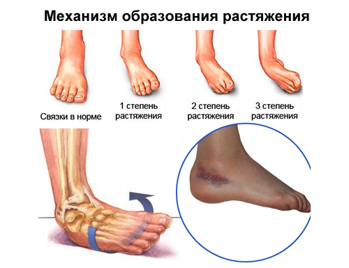 Степени растяжения стопы