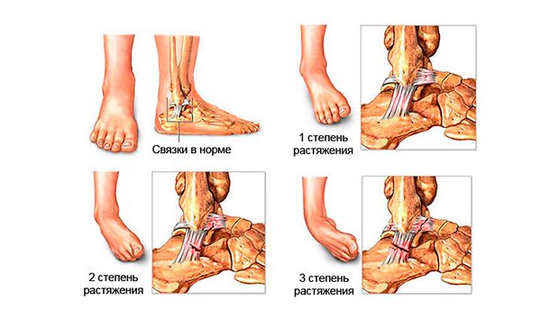 Степени растяжения связок голеностопа Степени растяжения связок голеностопа
